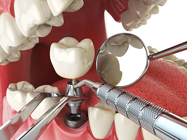 Best Broken or Chipped Tooth Repair in Allyn, WA